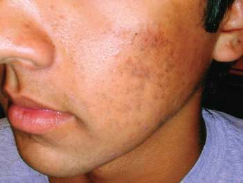 Acne Post Treatment