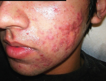 Acne Before Treatment